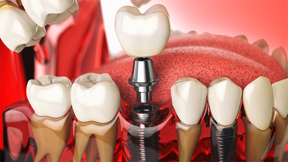 Tooth implant in the model human teeth, gums and denturas. Denta