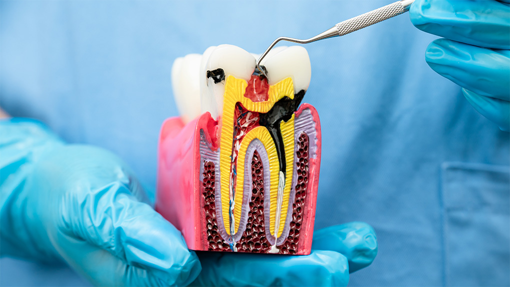 Root Canal Treatment in Turkey