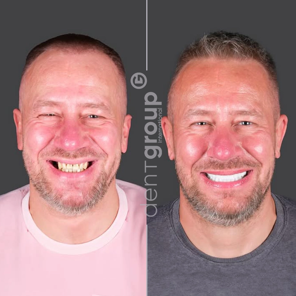 Before and after full mouth dental implants — UK patient, both jaws restored, Dent Group International Antalya