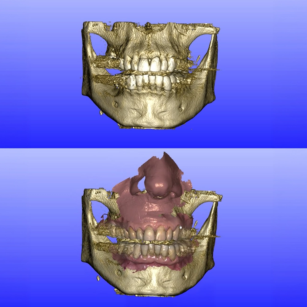 Computer-guided surgical guide used at Dentgroup International for accurate implant placement