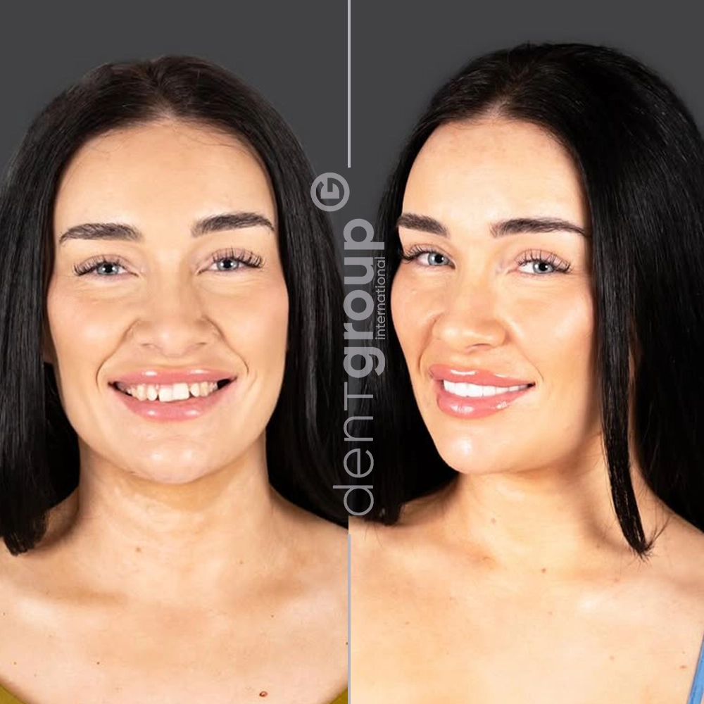 Before and after full mouth dental implants — complete restoration with zirconia bridge, Dent Group International
