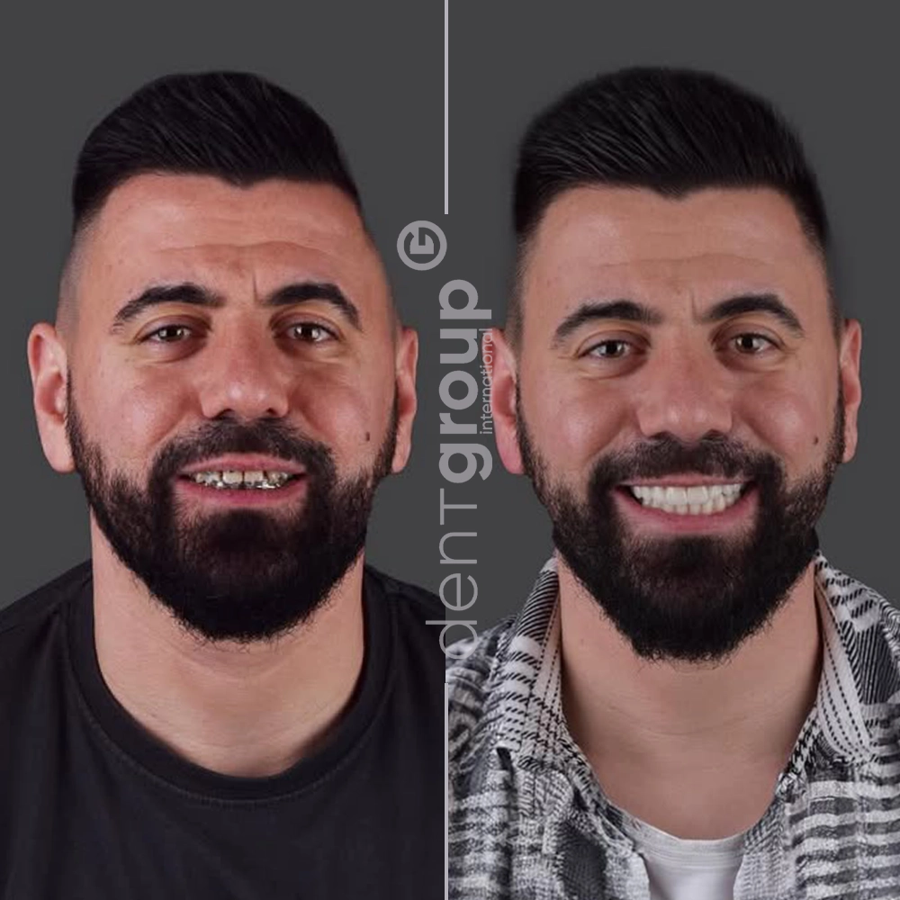 Before and after full mouth dental implants — UK patient, complete smile restoration, Dent Group International Antalya