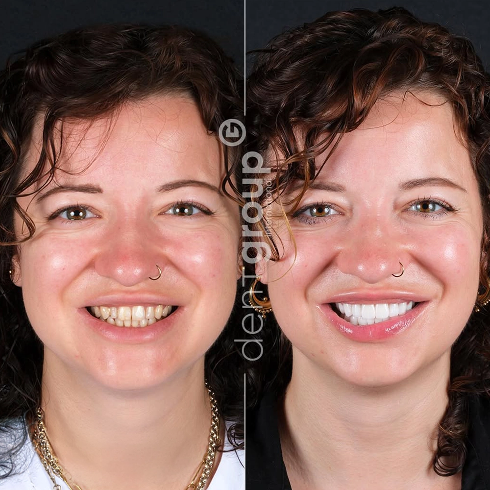 Before and after full mouth dental implants — UK patient, both jaws restored, Dent Group International Antalya