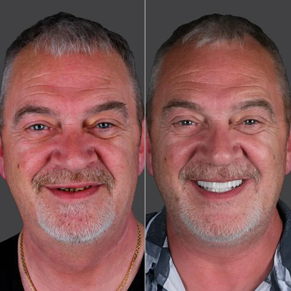 All-on-4 Implants Before and After — DentGroup International Antalya