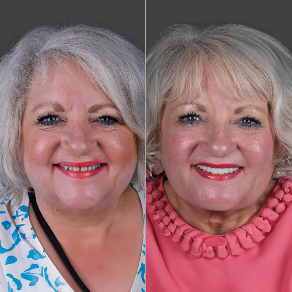 All-on-4 Dental Implants Before and After — Antalya