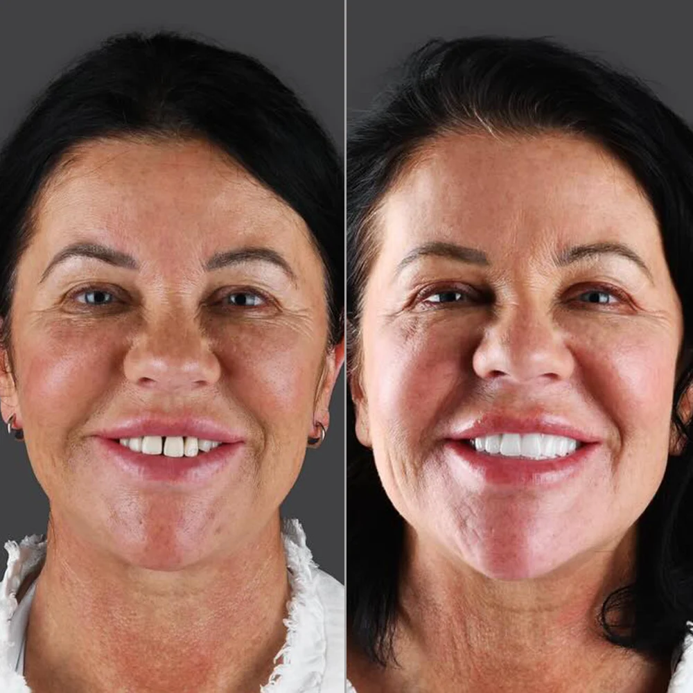 All-on-6 Implants Before and After — DentGroup International