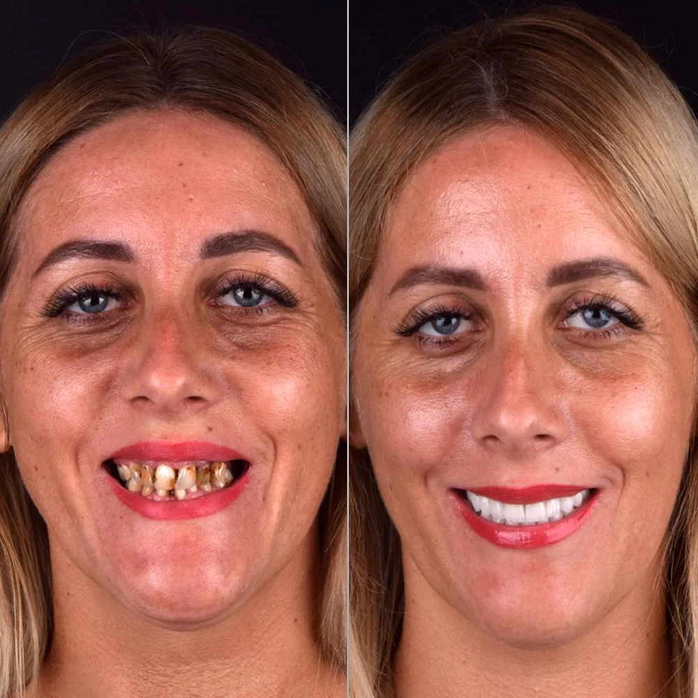 Dental Implants Before and After — Antalya Turkey