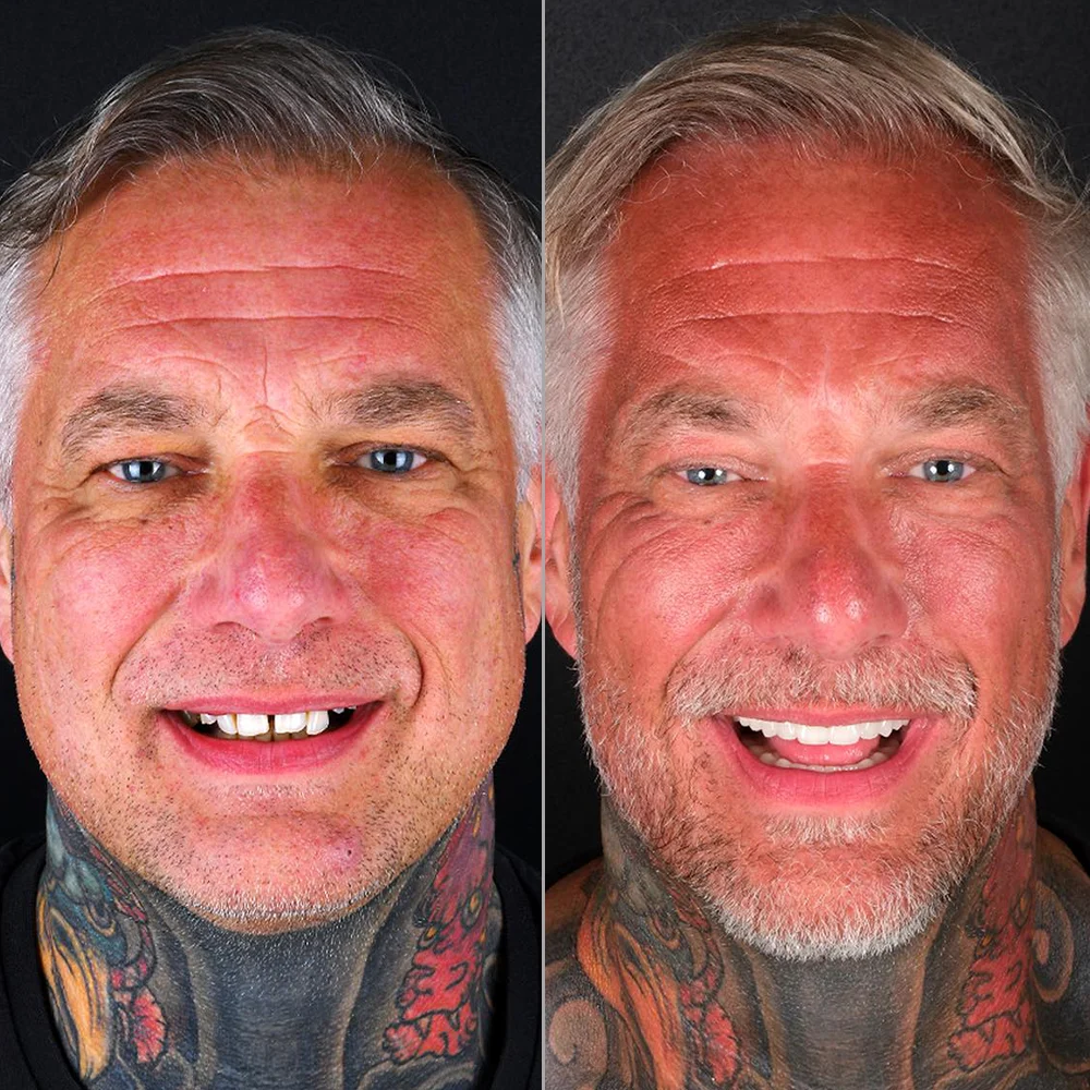 Dental Implant Before and After — Antalya Clinic