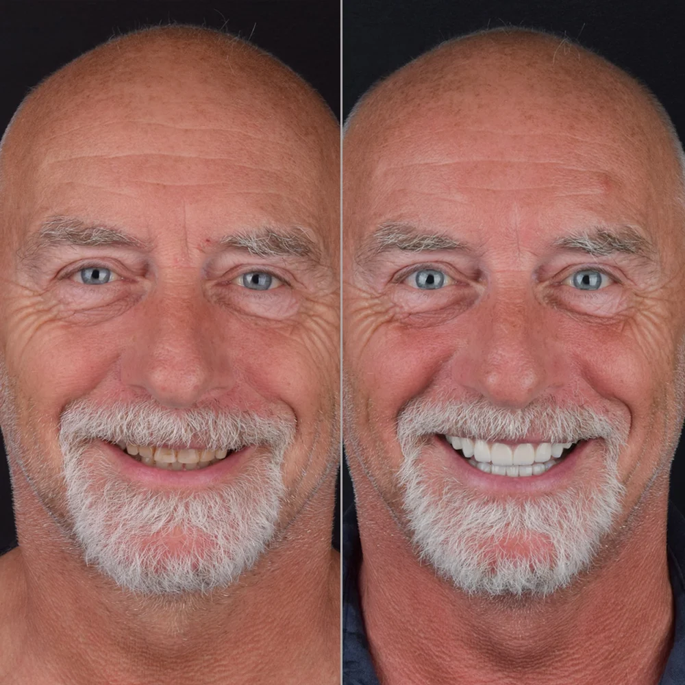 Implant Treatment Before and After — DentGroup International