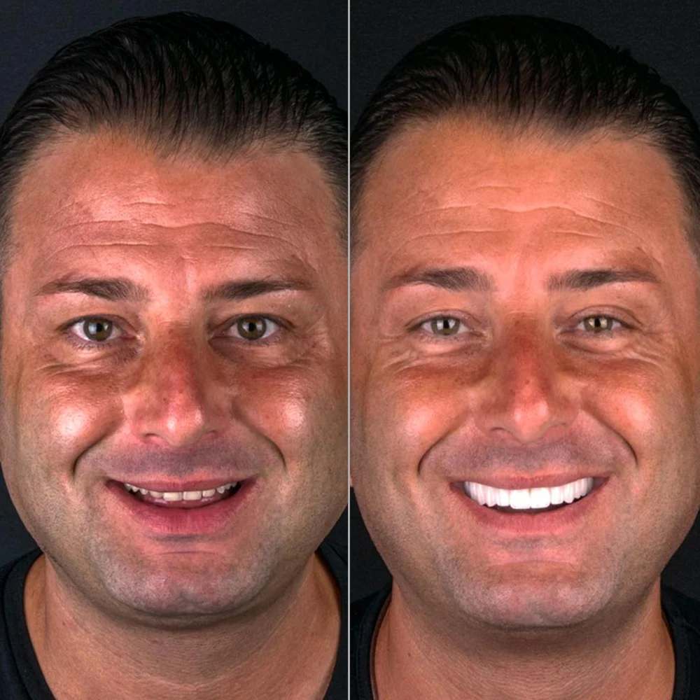 Hollywood Smile Before and After — DentGroup International Antalya