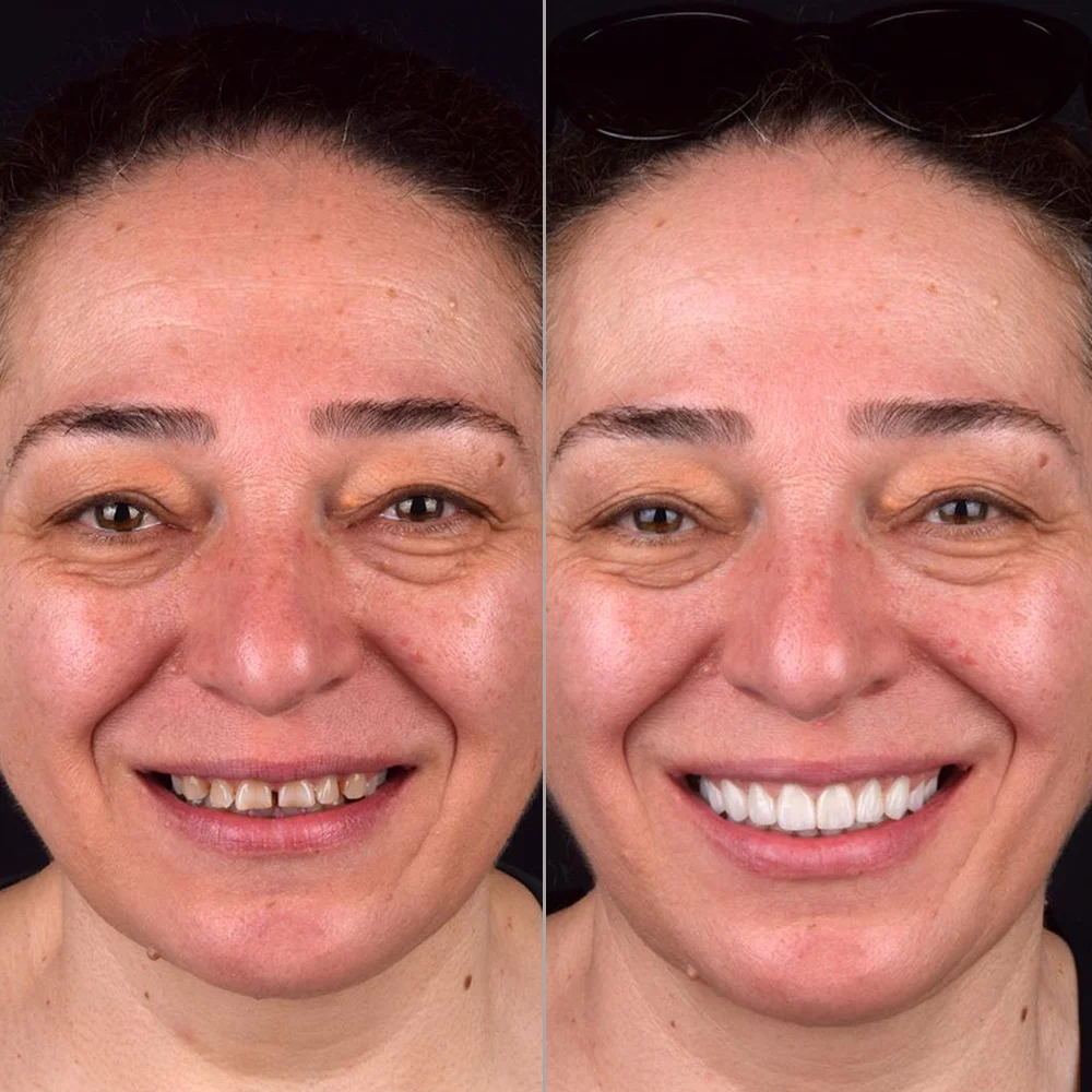 Smile Restoration Before and After — DentGroup International Antalya