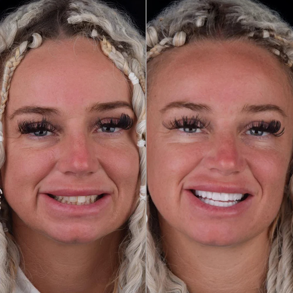 Zirconium Crowns Before and After — DentGroup International Antalya