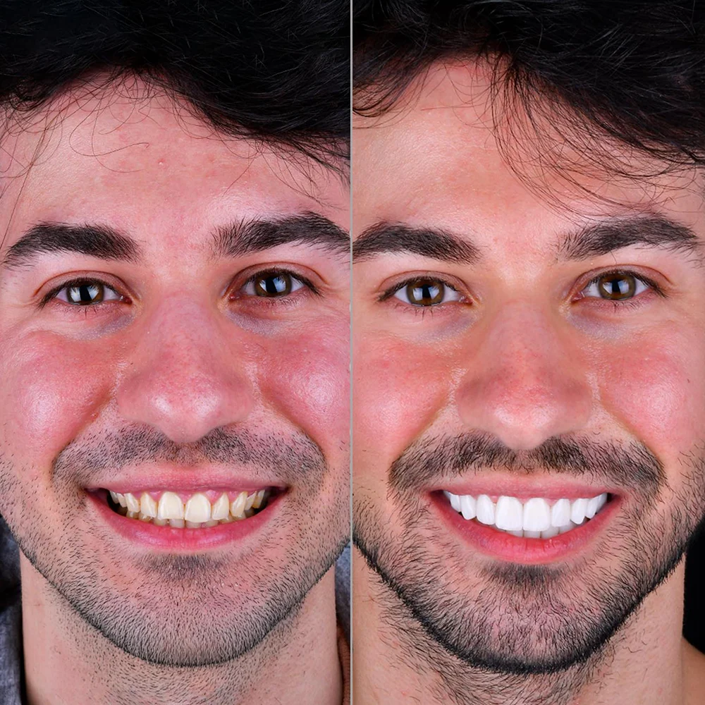 Smile Makeover Before and After — DentGroup International Antalya