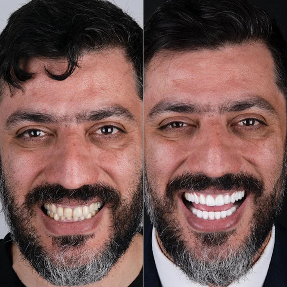 Zirconium Crowns Before and After — DentGroup International Antalya